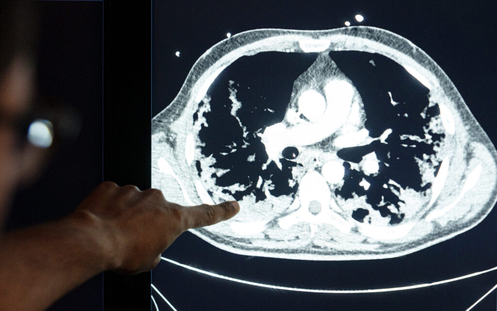Long COVID bij een patiënt © Thijs Rooijmans 